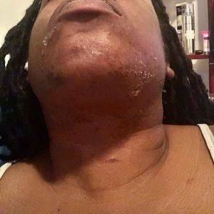 Chin peel for lower face acne